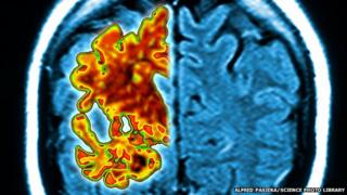 Alzheimer’s: ‘Promising’ blood test for early stage of disease